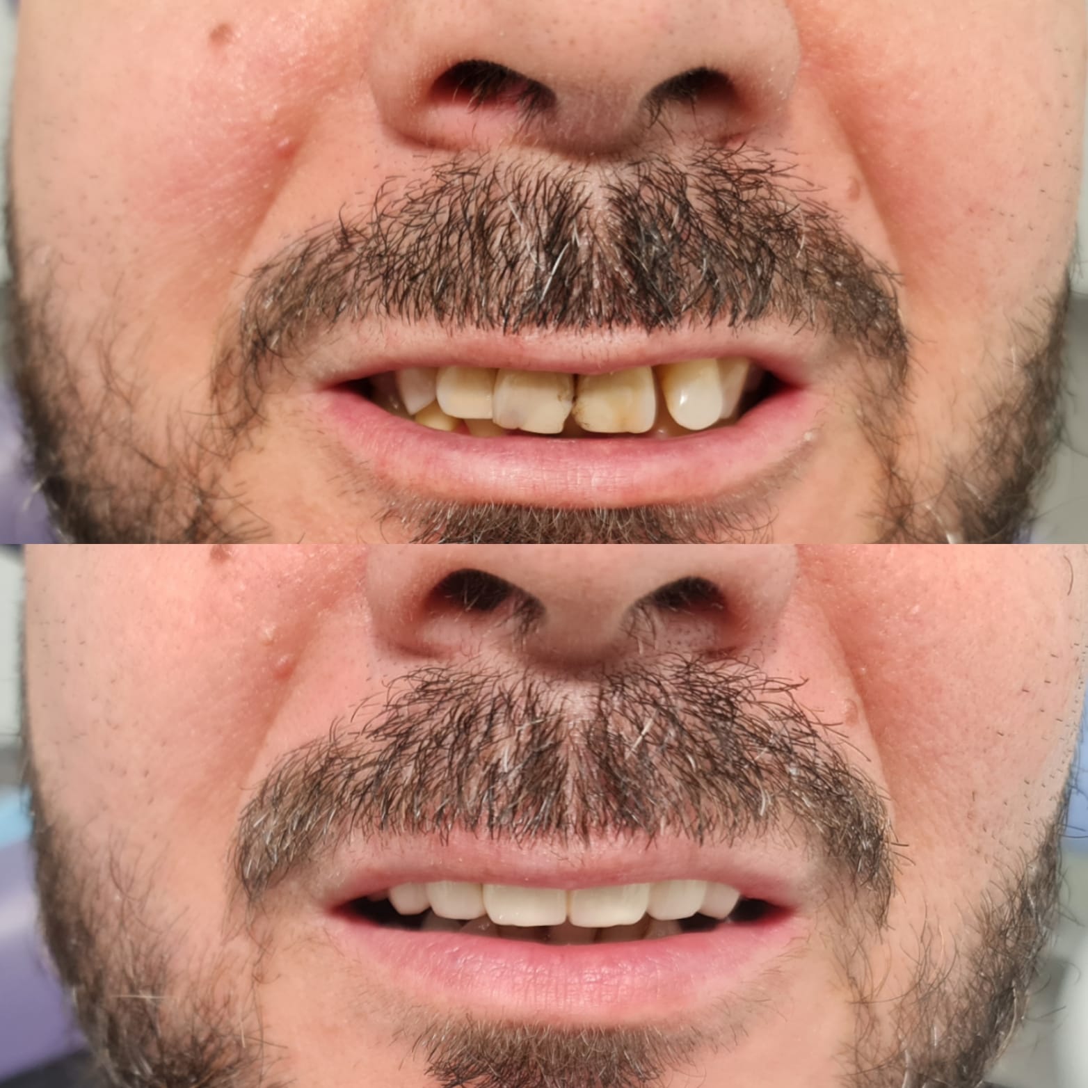 Antes y después caso clínico 19