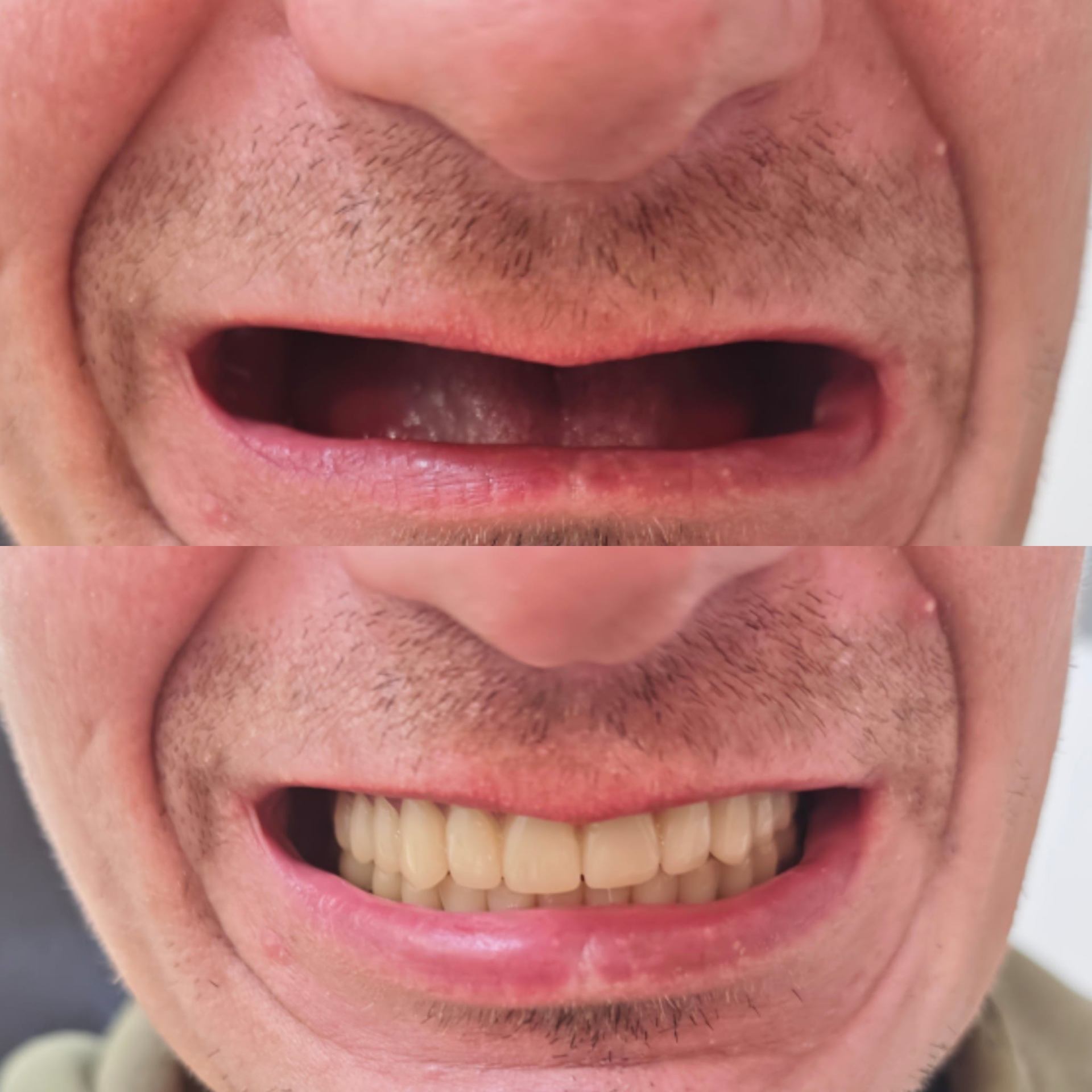 Antes y después caso clínico 21