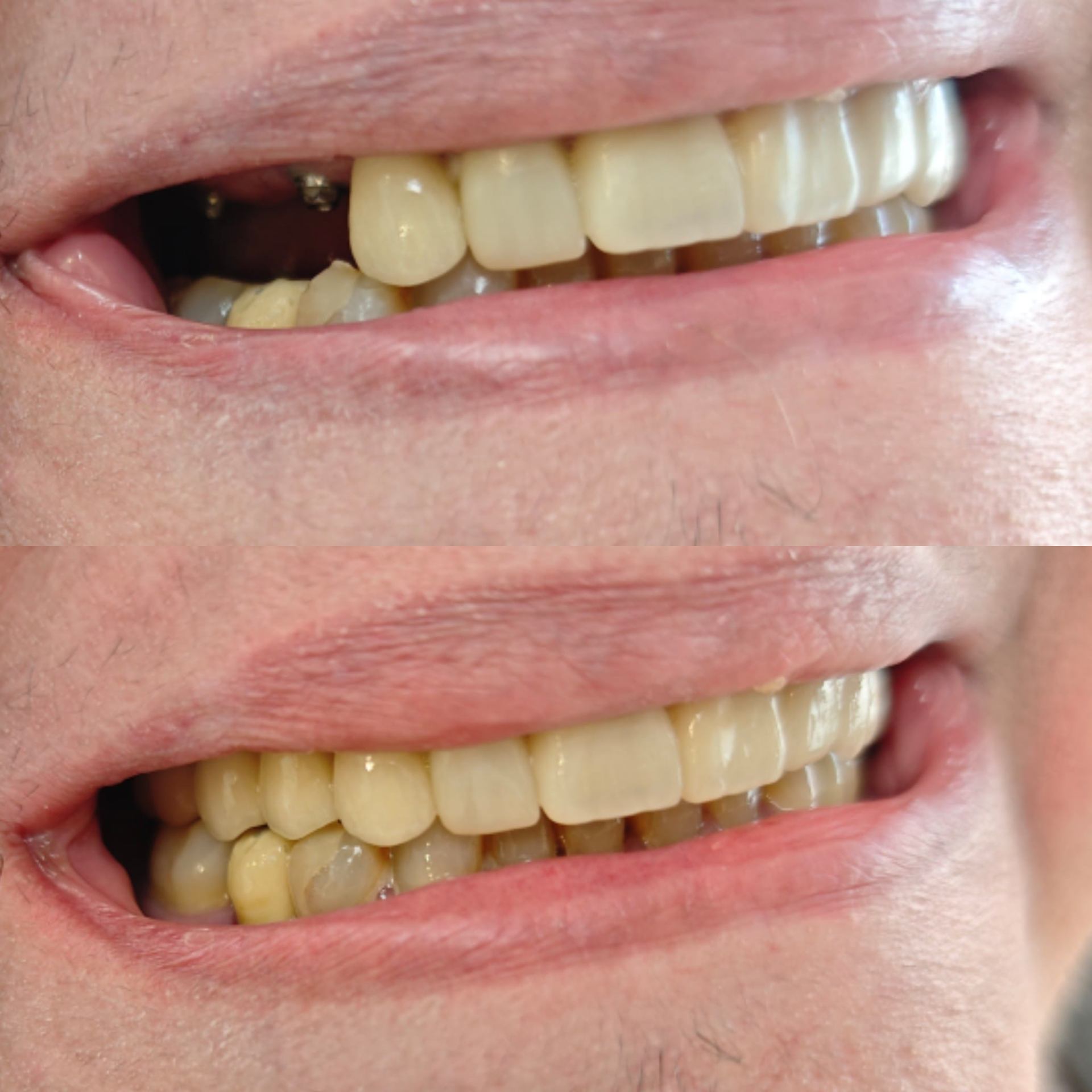 Antes y después caso clínico 22