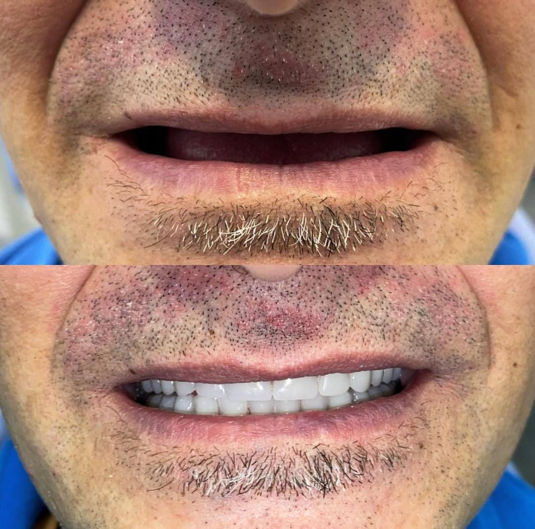 Antes y después caso clínico 30