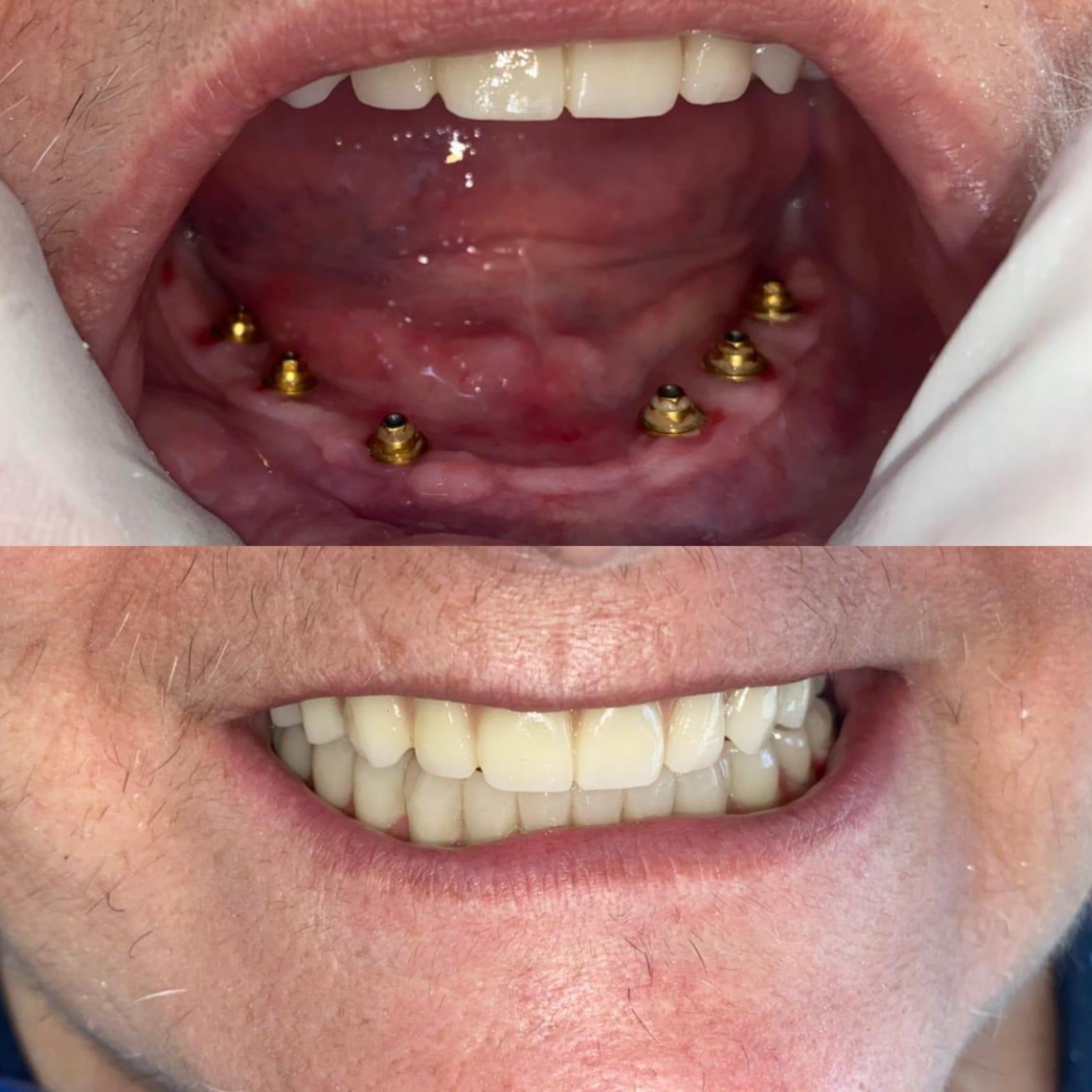Antes y después caso clínico 4